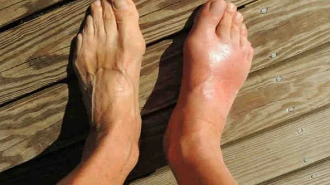 Sering Disepelekan, Buah Liar Ini Obat Asam Urat Paling Ampuh