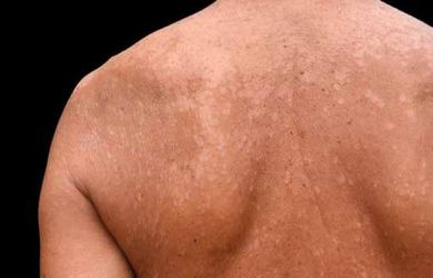 Berikut Tips dan Trik Menghilangkan Panu Secara Alami, Coba Deh Biar Nggak Malu!