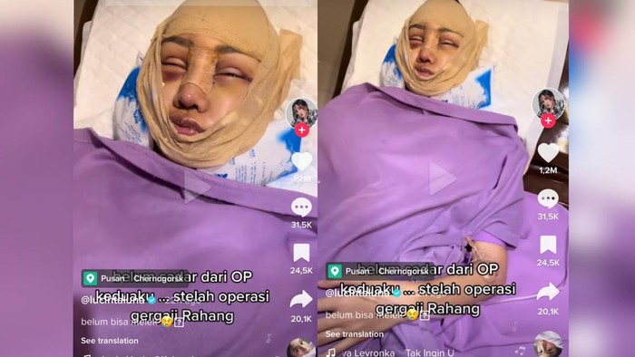 Lucinta Luna Belum Bisa Banyak Bicara, Mohon Doa Operasi Tahap Terakhir