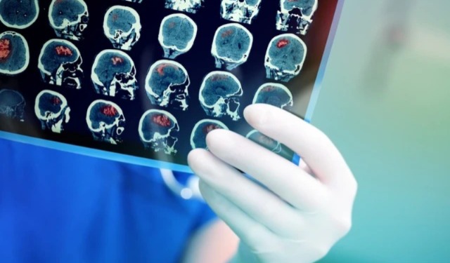 Dianggap Sepele, Ini 7 Gejala Sederhana Tanda Seseorang Kena Kanker Otak