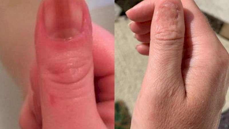 Kamu Miliki Garis Hitam di Kuku, Bisa Saja Itu Tanda Penyakit Kanker yang Mematikan