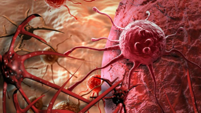 Ini Dia Makanan Penyebab Kanker Terbesar