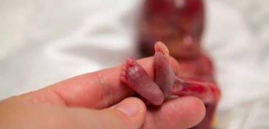 Mahasiswi Ini Pilih Aborsi Meski Sang Pacar Mau Tanggung Jawab, Ini Alasannya