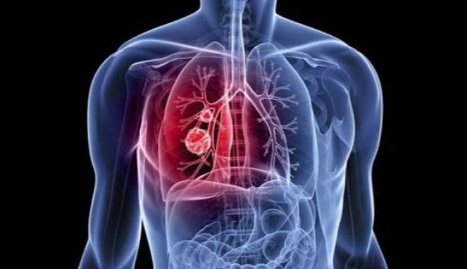 5 Gejala Kanker Paru-paru yang Sering Diabaikan