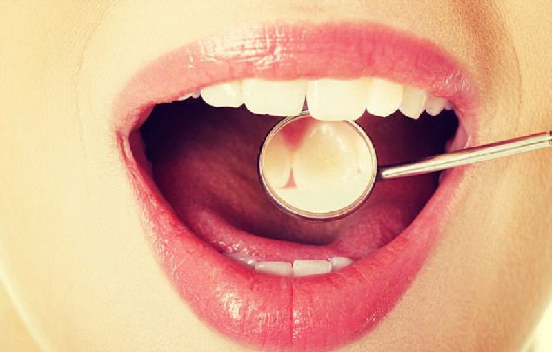 Tak Mau Kena Karang Gigi, Coba 4 Tips Ini