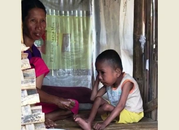 Waah, Bocah Gizi Buruk Dekat Rumah Pak Kades, Bupati Langsung Murka