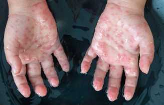 Hasil Labor Kemenkes, 2 Warga Kepulauan Meranti Dipastikan Negatif Virus Cacar Monyet