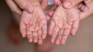 Campak Anak: Akut dan Sangat Menular! Jangan Abaikan Imunisasi