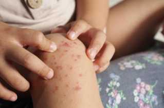 WHO Sebut Mpox Tidak Separah Covid-19