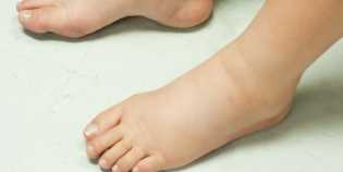 Berikut Lima Cara Mudah Mengatasi Tangan dan Kaki yang Bengkak ketika Hamil