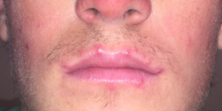 Obati dan Hindari Jerawat di Bibir dengan Berbagai Cara Berikut