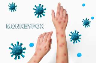 1 Pasien Cacar Monyet Meninggal Dunia, Ini Penjelasan Dokter