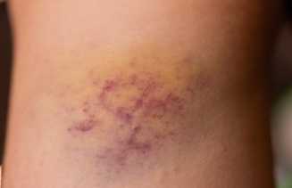 Lebam Mendadak Disebabkan Dijilat Setan, Mitos atau Fakta?