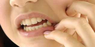 Lima Makanan yang Tanpa Diduga Bisa Menyebabkan Gigi Menjadi Retak