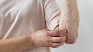 Kenali Infeksi Primer Varicella Zoster Virus (VZV) yang Diderita Anak